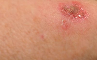 When to Keep Wounds Moist or Dry?