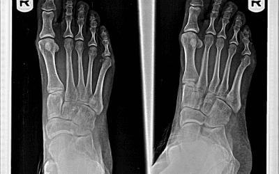 Stress Fractures